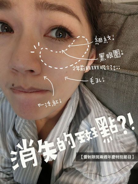 消失的斑點 – 馬克媽媽的雷射除斑兩週年慶